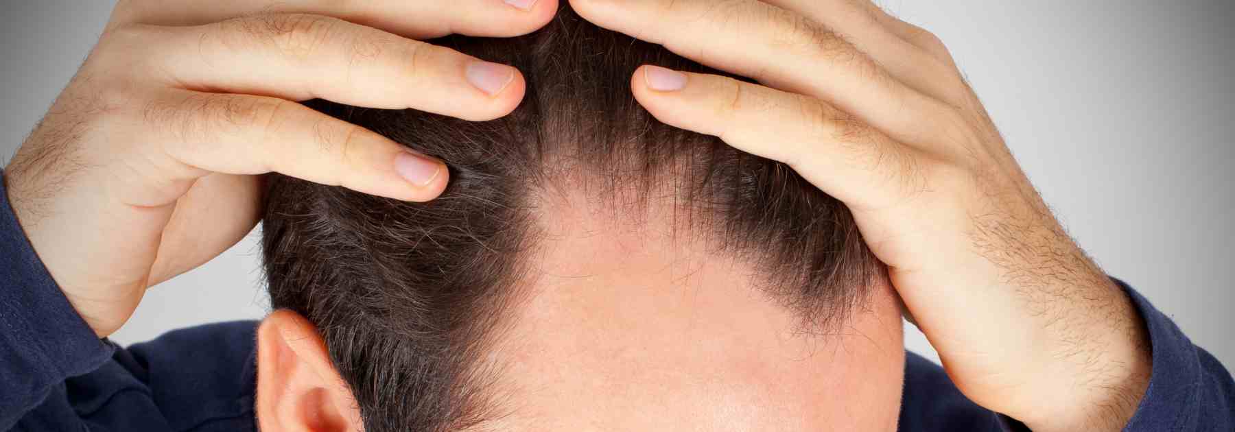 What are the differences between finasteride and minoxidil for hair loss?