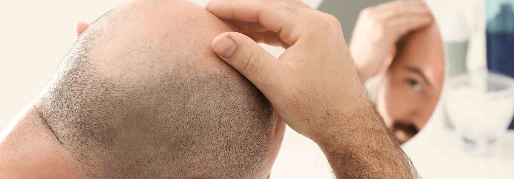 Struggling with crown hair loss?