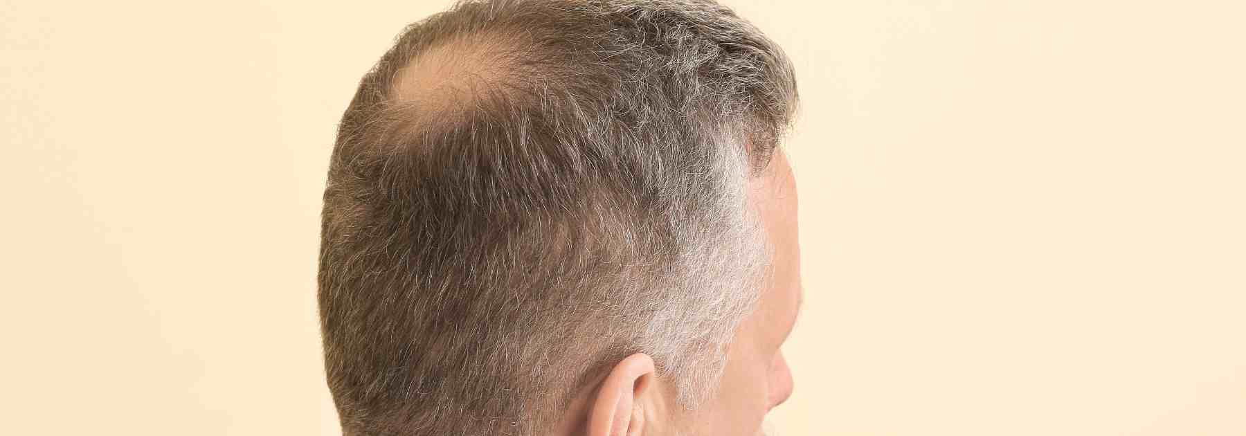 Does finasteride 1mg work for crown hair loss?