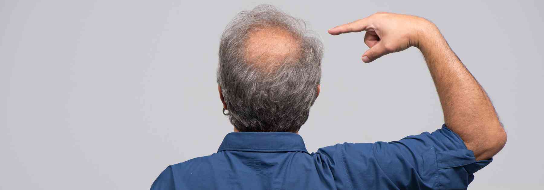 male pattern hair loss treatment