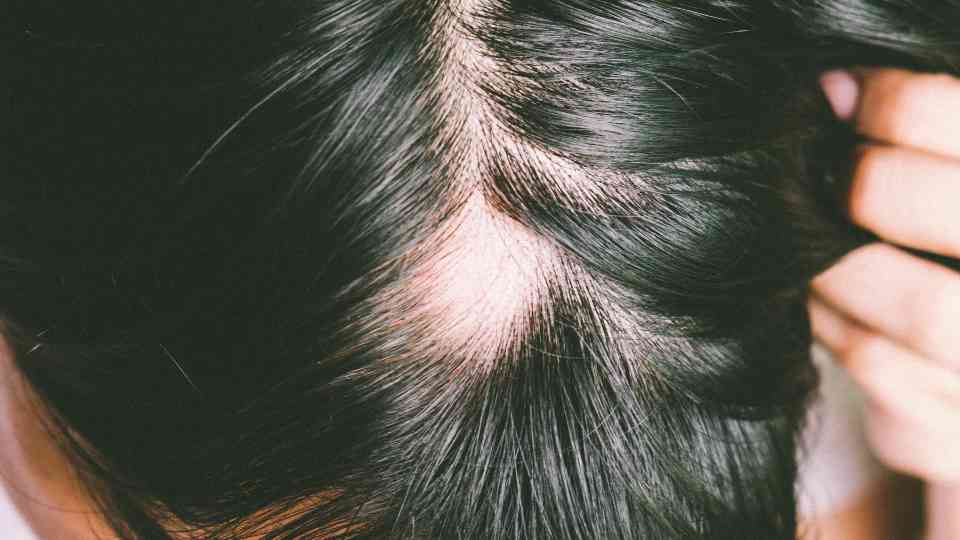 balding men scotland