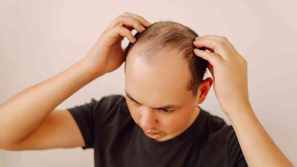 male pattern hair loss uk