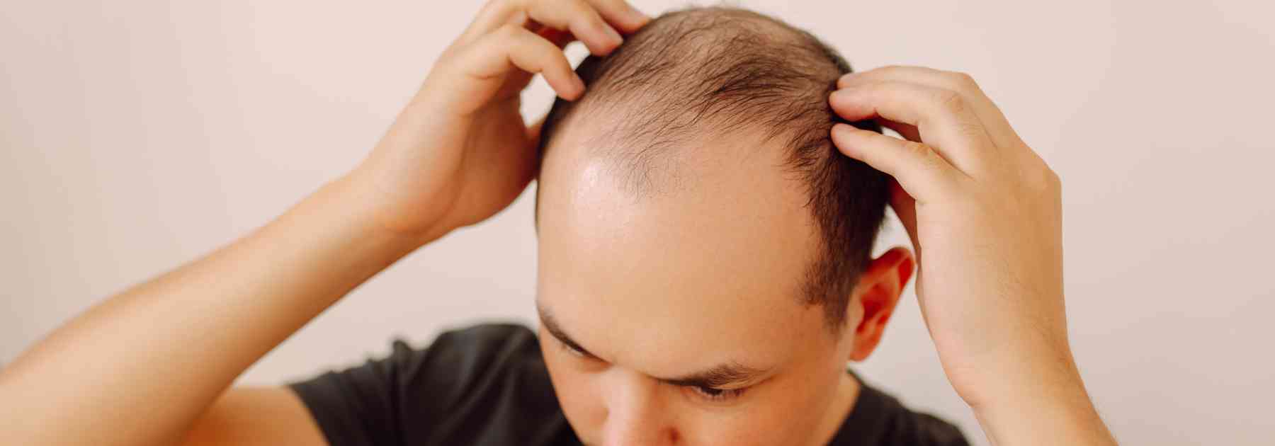 oral minoxidil hair loss
