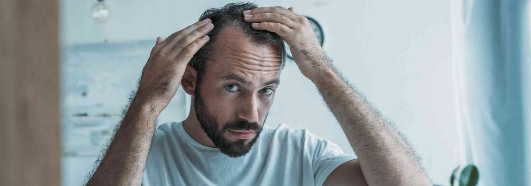 how to manage receding hair